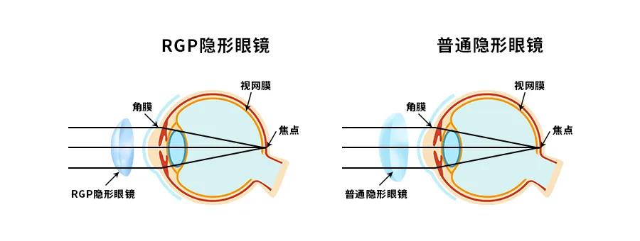 眼科科普丨角膜接触镜,儿童能戴吗?