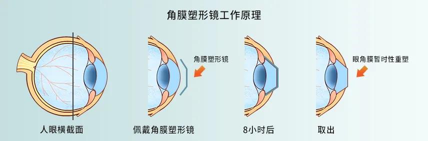 眼科科普丨角膜接触镜,儿童能戴吗?